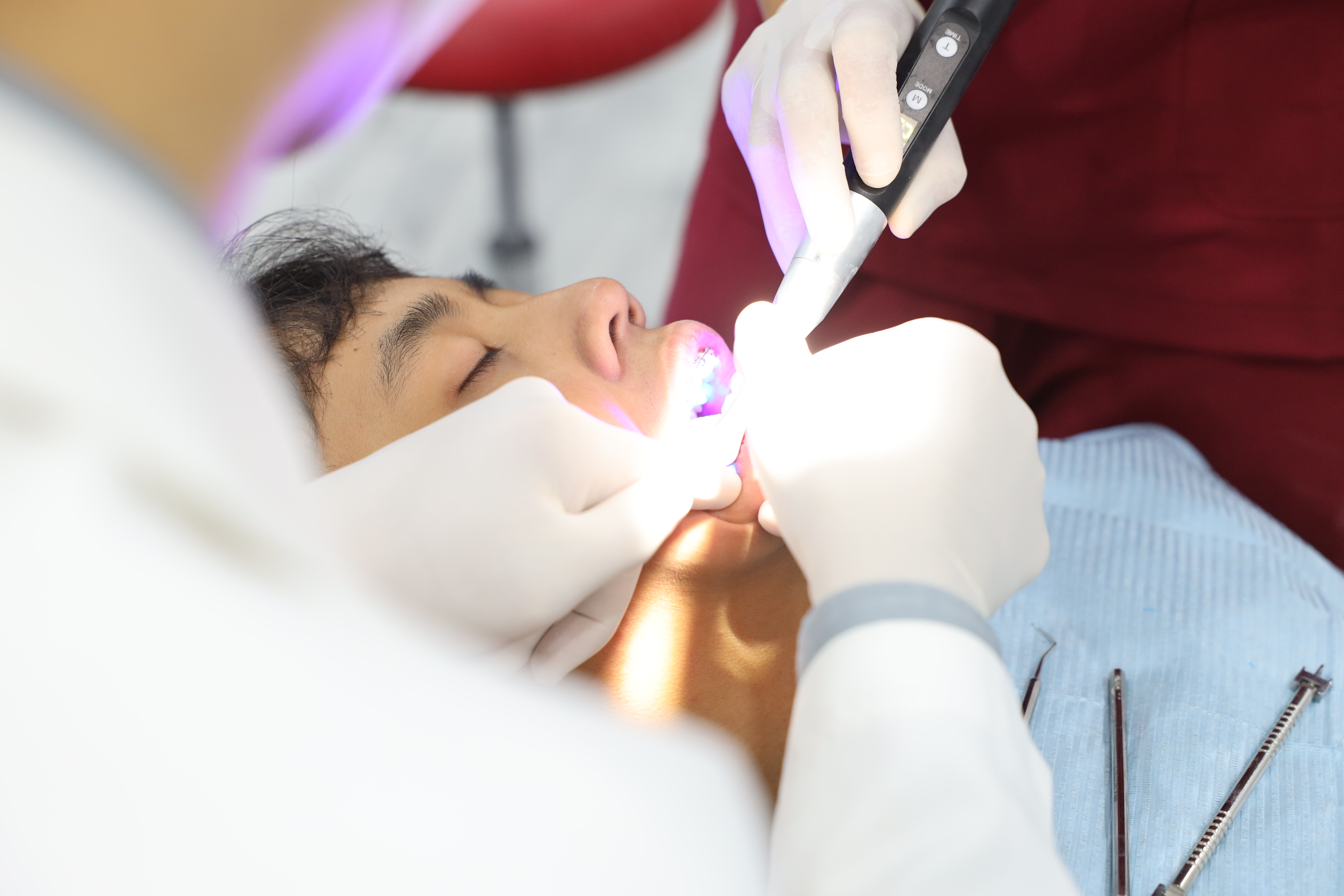 Trám răng sâu an toàn tại Home Dentist