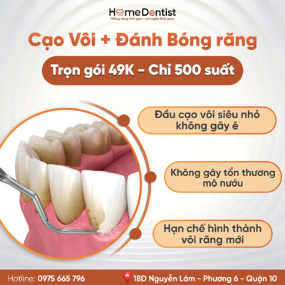 Cạo vôi đánh bóng ưu đãi 49K