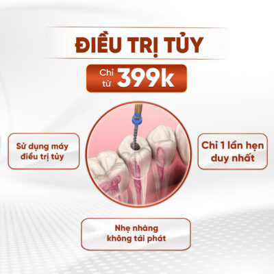 Điều trị tủy răng với 1 lần hẹn