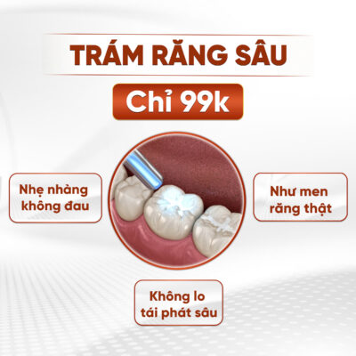 Trám răng sâu thẩm mỹ